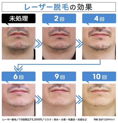 脱毛器 剃らずに|毛を剃らずに処理する方法: 11 ステップ (画像あり)